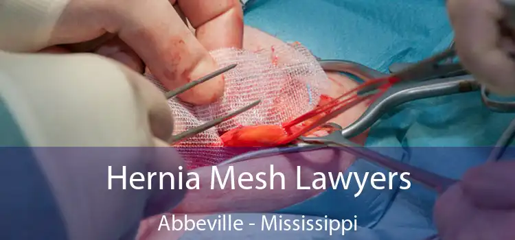 Hernia Mesh Lawyers Abbeville - Mississippi