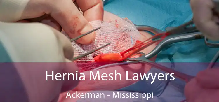 Hernia Mesh Lawyers Ackerman - Mississippi