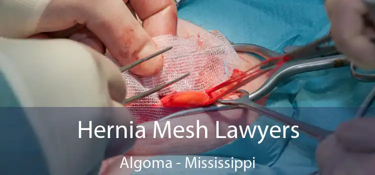 Hernia Mesh Lawyers Algoma - Mississippi