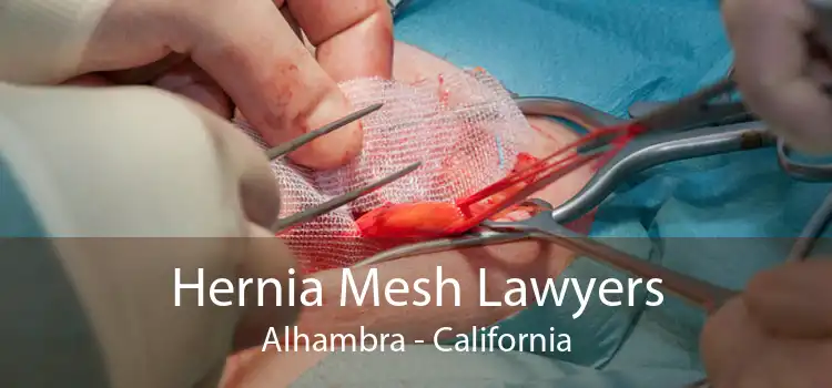 Hernia Mesh Lawyers Alhambra - California