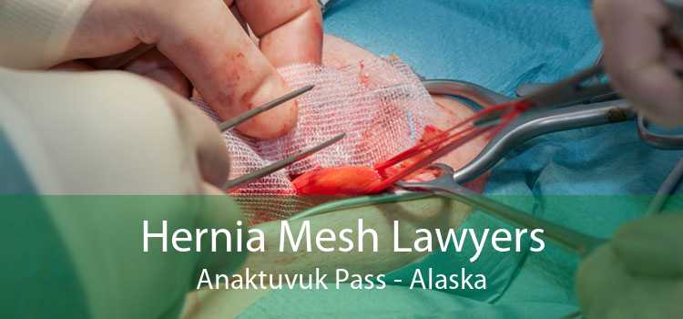 Hernia Mesh Lawyers Anaktuvuk Pass - Alaska