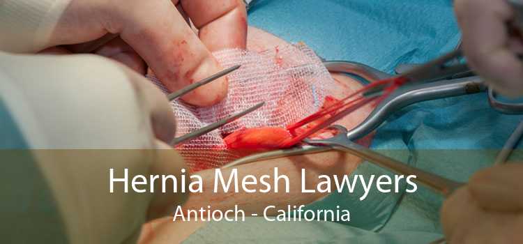Hernia Mesh Lawyers Antioch - California