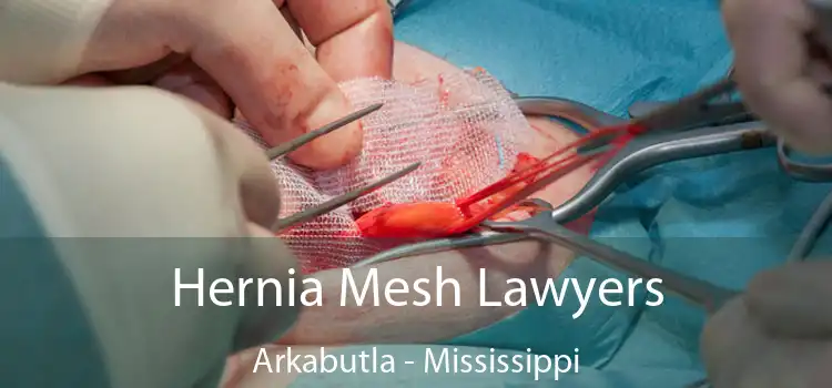 Hernia Mesh Lawyers Arkabutla - Mississippi