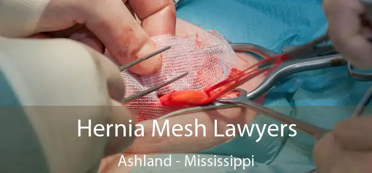 Hernia Mesh Lawyers Ashland - Mississippi