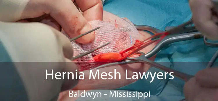 Hernia Mesh Lawyers Baldwyn - Mississippi