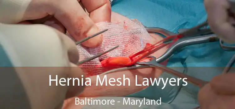 Hernia Mesh Lawyers Baltimore - Maryland