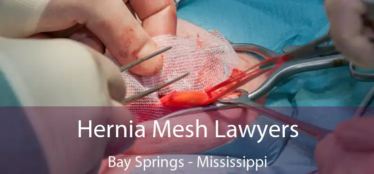 Hernia Mesh Lawyers Bay Springs - Mississippi