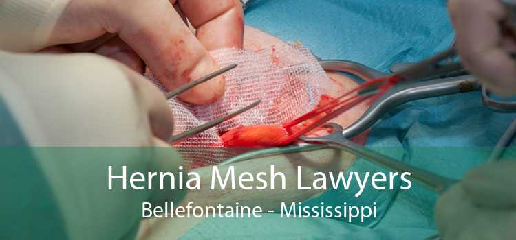 Hernia Mesh Lawyers Bellefontaine - Mississippi