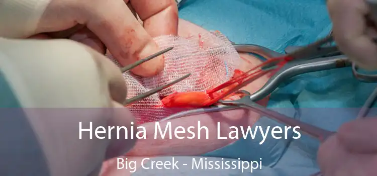 Hernia Mesh Lawyers Big Creek - Mississippi