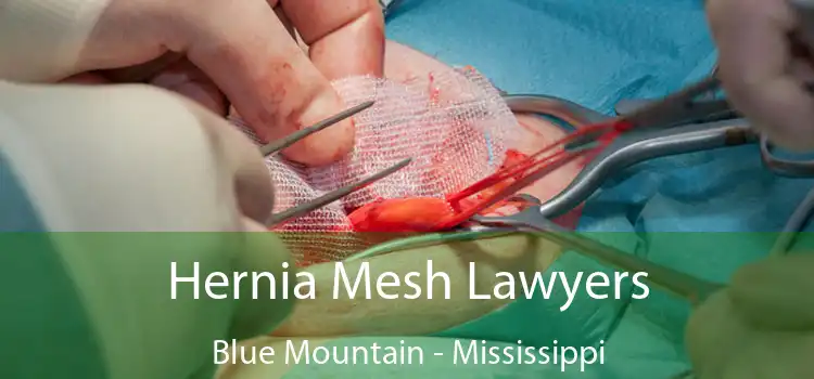 Hernia Mesh Lawyers Blue Mountain - Mississippi