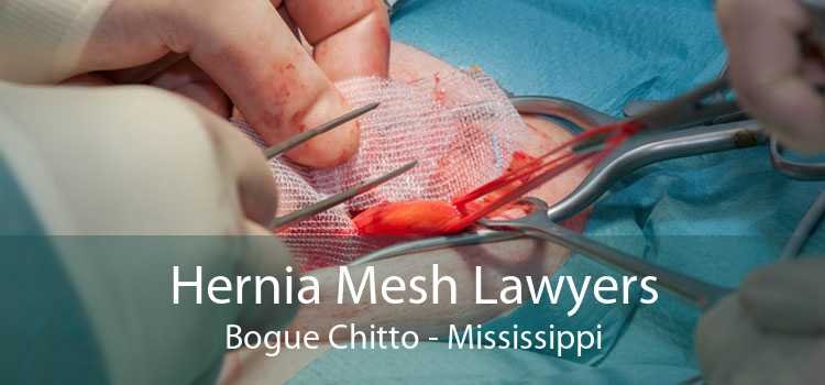 Hernia Mesh Lawyers Bogue Chitto - Mississippi