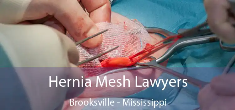 Hernia Mesh Lawyers Brooksville - Mississippi