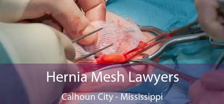 Hernia Mesh Lawyers Calhoun City - Mississippi