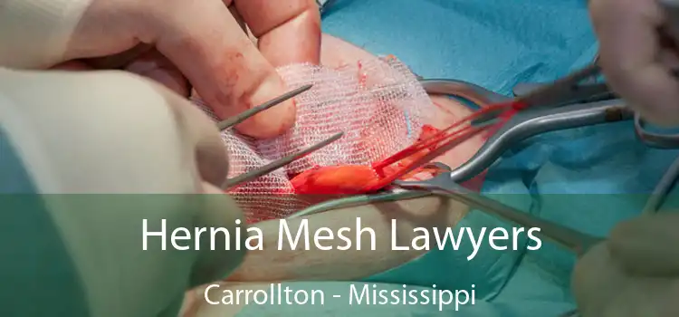 Hernia Mesh Lawyers Carrollton - Mississippi