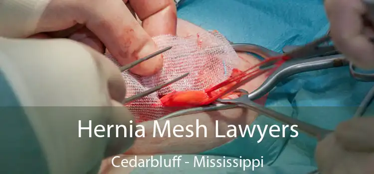 Hernia Mesh Lawyers Cedarbluff - Mississippi