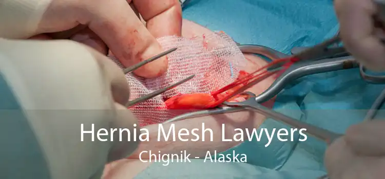Hernia Mesh Lawyers Chignik - Alaska