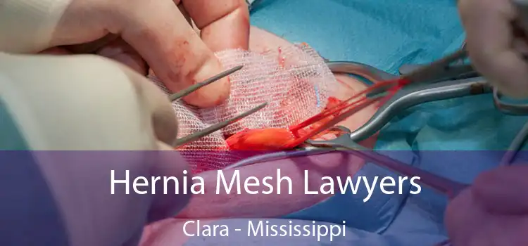 Hernia Mesh Lawyers Clara - Mississippi