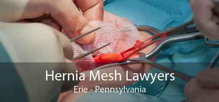 Hernia Mesh Lawyers Erie - Pennsylvania