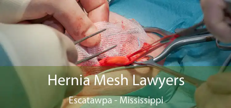 Hernia Mesh Lawyers Escatawpa - Mississippi