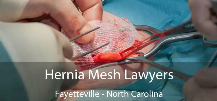 Hernia Mesh Lawyers Fayetteville - North Carolina