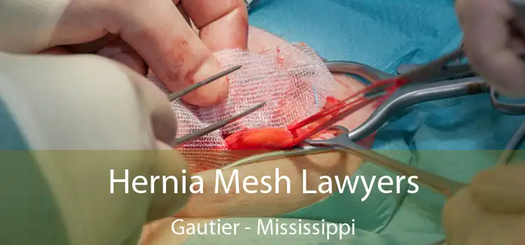 Hernia Mesh Lawyers Gautier - Mississippi