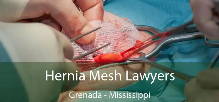 Hernia Mesh Lawyers Grenada - Mississippi