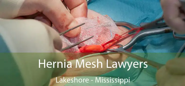 Hernia Mesh Lawyers Lakeshore - Mississippi