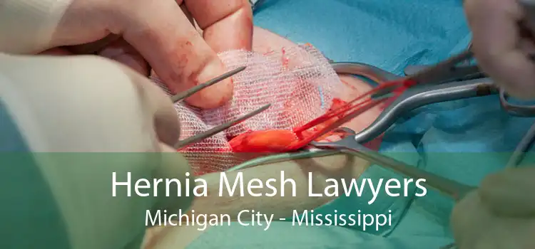 Hernia Mesh Lawyers Michigan City - Mississippi