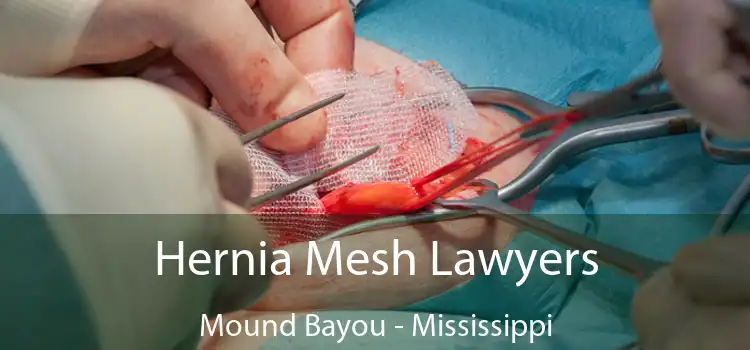 Hernia Mesh Lawyers Mound Bayou - Mississippi