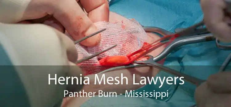 Hernia Mesh Lawyers Panther Burn - Mississippi