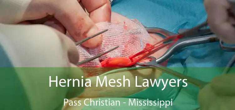 Hernia Mesh Lawyers Pass Christian - Mississippi