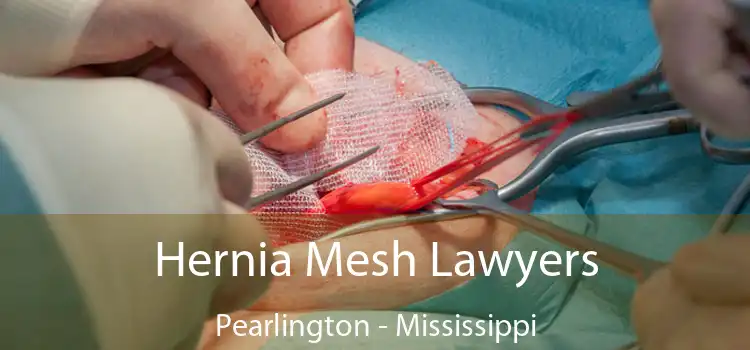 Hernia Mesh Lawyers Pearlington - Mississippi