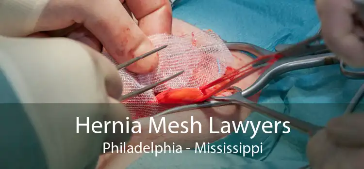 Hernia Mesh Lawyers Philadelphia - Mississippi