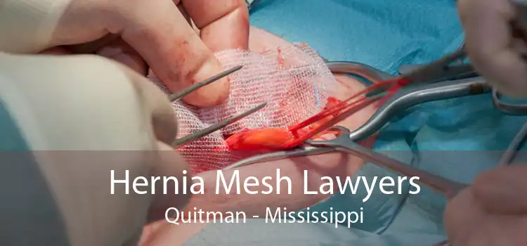 Hernia Mesh Lawyers Quitman - Mississippi