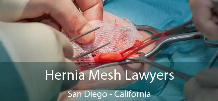 Hernia Mesh Lawyers San Diego - California