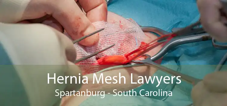 Hernia Mesh Lawyers Spartanburg - South Carolina
