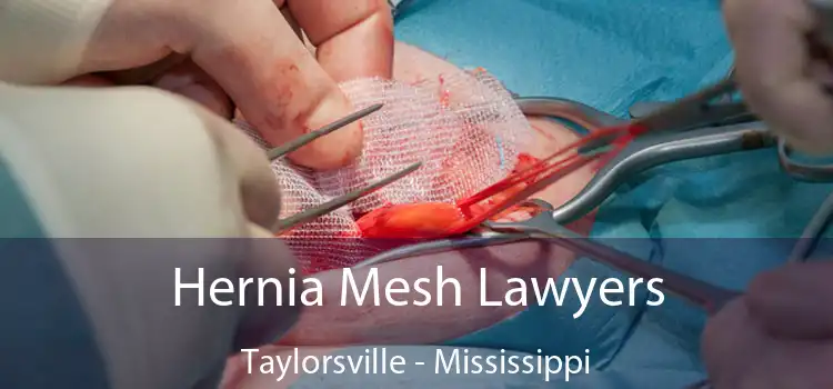 Hernia Mesh Lawyers Taylorsville - Mississippi