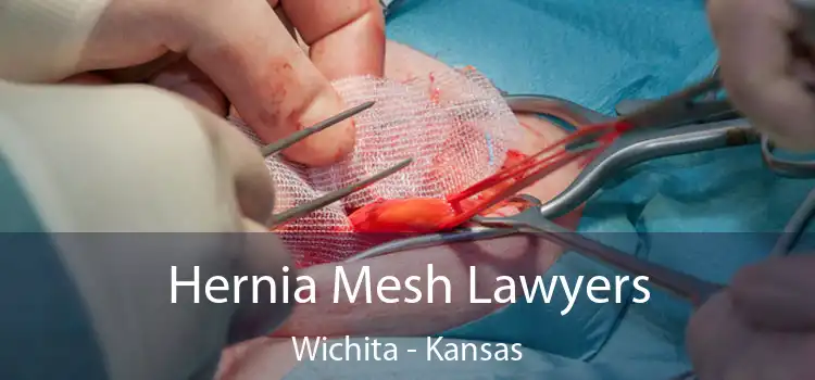 Hernia Mesh Lawyers Wichita - Kansas