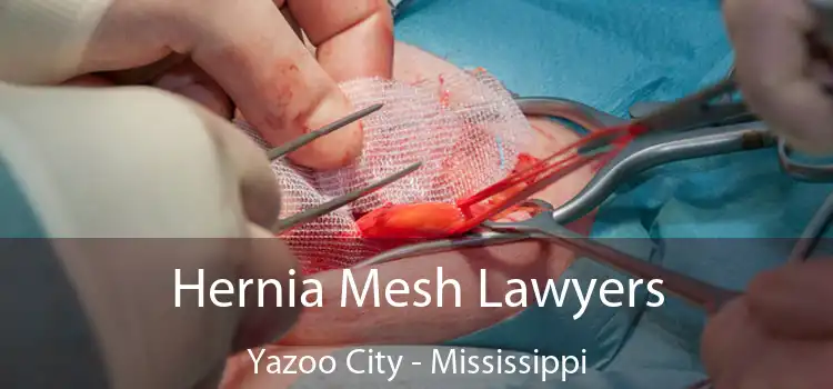 Hernia Mesh Lawyers Yazoo City - Mississippi