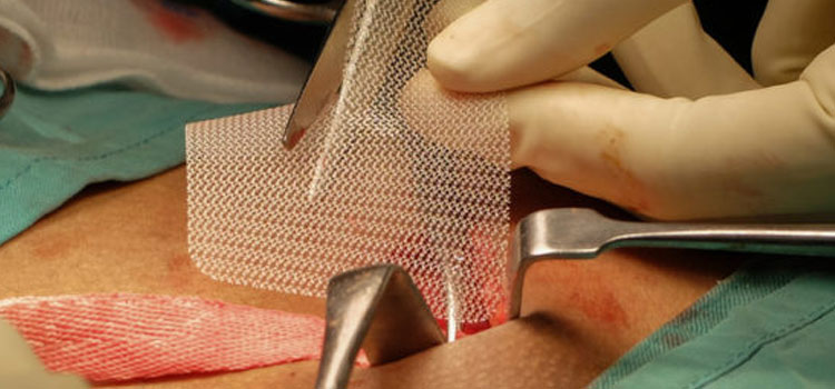 Hernia Mesh Surgery in Barnstable Town